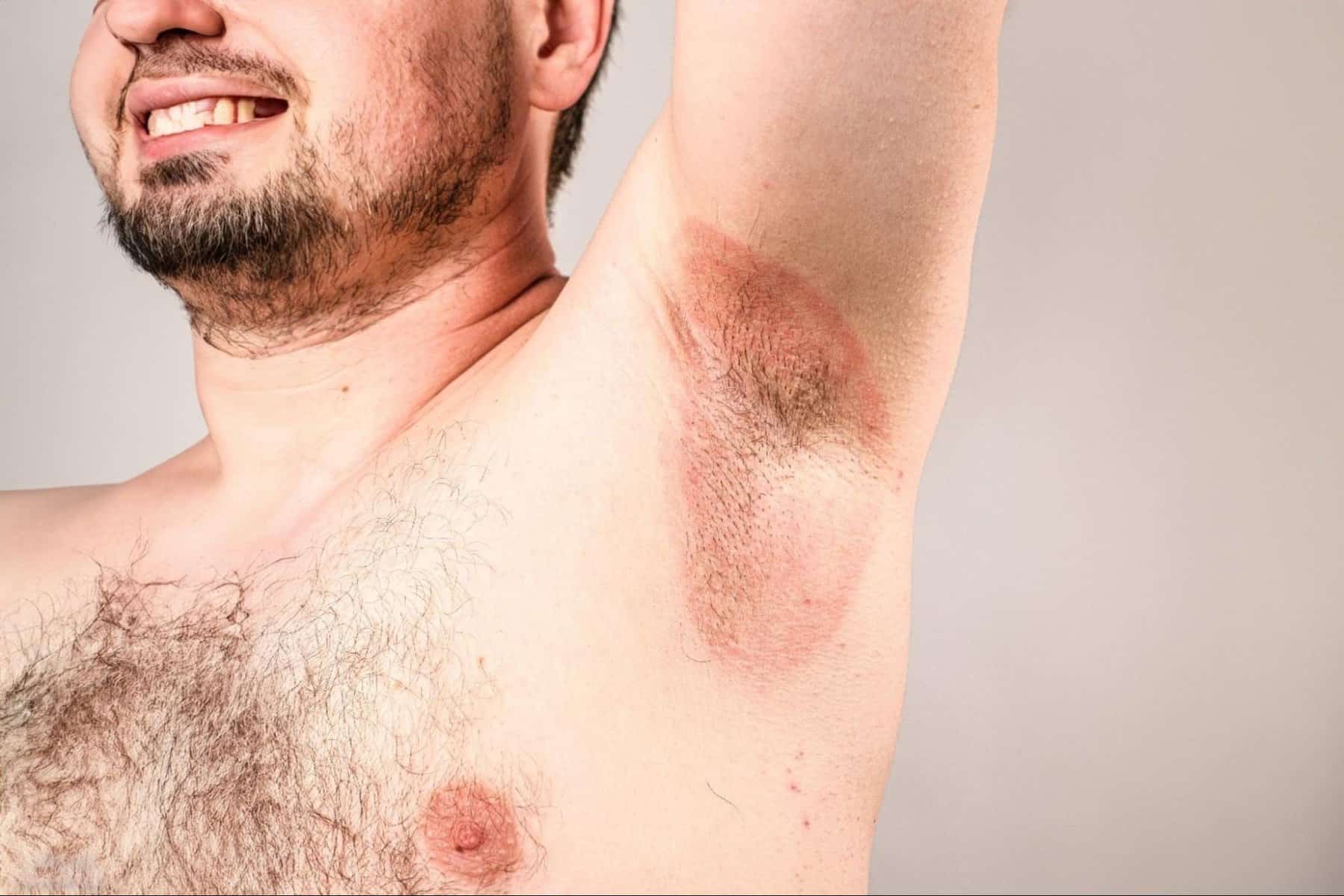 Armpit Rash 7 Causes And How To Treat It 