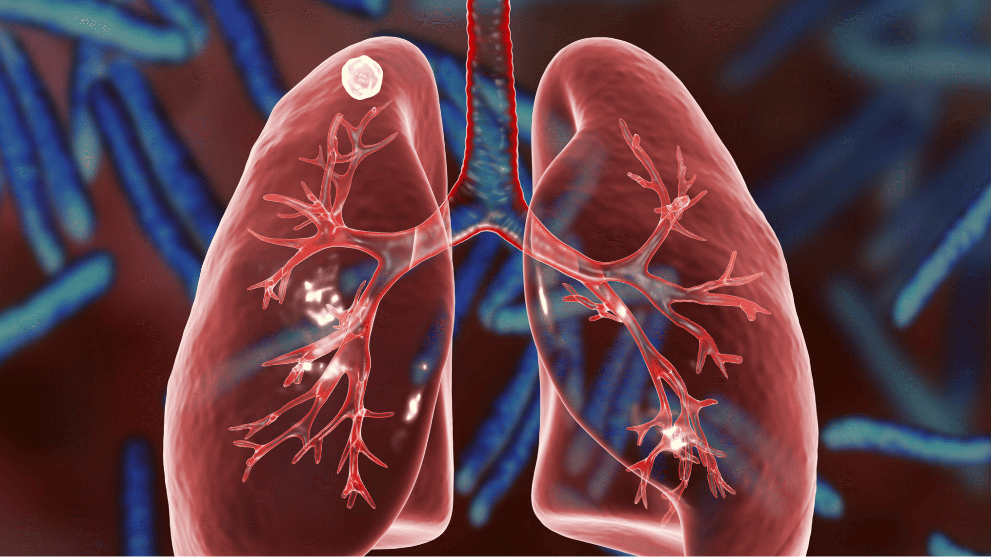 lung-nodules-symptoms-causes-diagnosis-treatment-healthnile