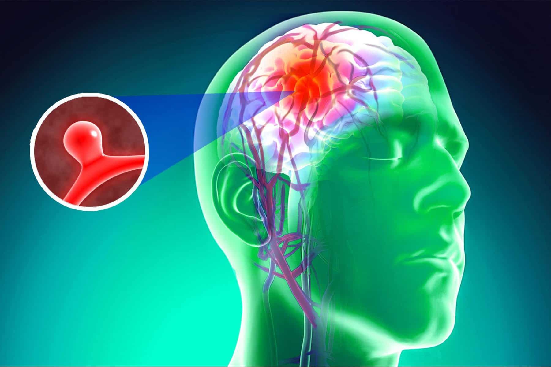 Brain Aneurysms: Symptoms, Causes, Diagnosis & Treatment - HealthNile.com